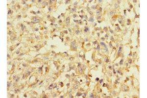 Immunohistochemistry of paraffin-embedded human melanoma using ABIN7144587 at dilution of 1:100 (AVPI1 Antikörper  (AA 1-147))