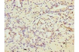 Immunohistochemistry of paraffin-embedded human lung cancer using ABIN7175372 at dilution of 1:100 (VEGFC Antikörper  (AA 112-227))