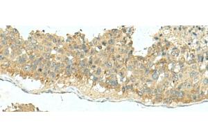 Immunohistochemistry of paraffin-embedded Human liver cancer tissue using KIR2DL5A Polyclonal Antibody at dilution of 1:40(x200) (KIR2DL5A Antikörper)