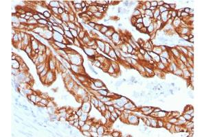 Formalin-fixed, paraffin-embedded human Colon Carcinoma stained with CK18 Rabbit Recombinant Monoclonal Antibody (KRT18/2808R). (Rekombinanter Cytokeratin 18 Antikörper)