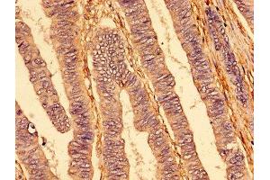 IHC image of ABIN7173825 diluted at 1:400 and staining in paraffin-embedded human colon cancer performed on a Leica BondTM system. (TNFRSF1A Antikörper  (AA 263-468))