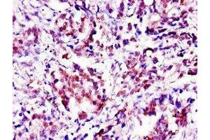 Immunohistochemistry of paraffin-embedded human gastric cancer using ABIN7144491 at dilution of 1:100