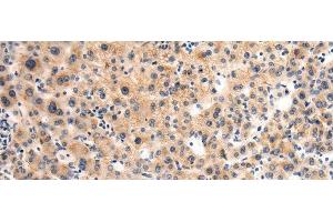 Immunohistochemistry of paraffin-embedded Human liver cancer tissue using GLT8D1 Polyclonal Antibody at dilution of 1:90(x200) (GLT8D1 Antikörper)