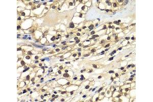 Immunohistochemistry of paraffin-embedded Human kidney cancer using ZNF169 Polyclonal Antibody at dilution of 1:100 (40x lens). (ZNF169 Antikörper)
