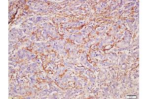 Formalin-fixed and paraffin embedded human gastric carcinoma labeled with Rabbit Anti-CADM2 Polyclonal Antibody, Unconjugated (ABIN1386792) at 1:200 followed by conjugation to the secondary antibody and DAB staining (CADM2 Antikörper  (AA 125-250))