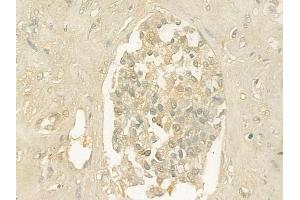 ABIN6261438 and ABIN6276426 at 1/100 staining human prostate carcinoma by IHC-P. (eEF1A1 Antikörper  (Internal Region))