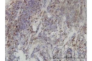 Immunoperoxidase of monoclonal antibody to MTHFD2 on formalin-fixed paraffin-embedded human lymphoma tissue.
