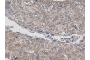 Detection of MRPL1 in Human Lung cancer Tissue using Polyclonal Antibody to Mitochondrial Ribosomal Protein L1 (MRPL1) (MRPL1 Antikörper  (AA 147-285))