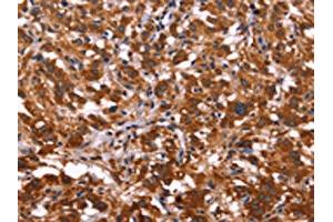 The image on the left is immunohistochemistry of paraffin-embedded Human thyroid cancer tissue using ABIN7128511(ARL4A Antibody) at dilution 1/50, on the right is treated with fusion protein. (ARL4A Antikörper)