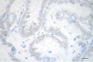 Immunohistochemistry was performed on paraffin-embedded human ovarian carcinoma using chromodomain helicase DNA binding protein 3 antibody (ABIN7798069), 1:200). (Rekombinanter CHD3 Antikörper)