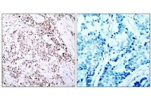 Immunohistochemical analysis of paraffin- embedded human breast carcinoma tissue using Estrogen Receptor-α (Ab-106) antibody (E021066). (Estrogen Receptor alpha Antikörper)