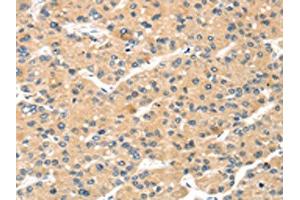 The image on the left is immunohistochemistry of paraffin-embedded Human liver cancer tissue using ABIN7191340(MAGEA11 Antibody) at dilution 1/20, on the right is treated with synthetic peptide. (MAGEA11 Antikörper)