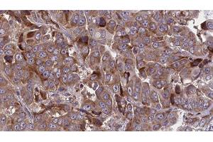 ABIN6277713 at 1/100 staining Human liver cancer tissue by IHC-P. (ATP1B1 Antikörper  (Internal Region))