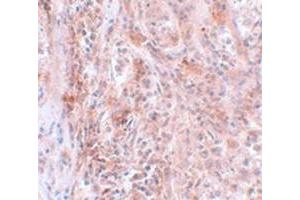 Immunohistochemical staining of human breast cancer tissue with BCAS2 polyclonal antibody  at 5 ug/mL dilution. (BCAS2 Antikörper  (C-Term))