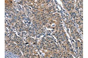 The image on the left is immunohistochemistry of paraffin-embedded Human gastric cancer tissue using ABIN7191907(PLA2G6 Antibody) at dilution 1/15, on the right is treated with synthetic peptide. (PLA2G6 Antikörper)