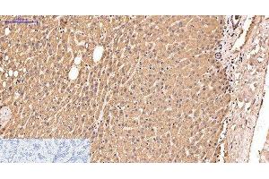 Immunohistochemistry of paraffin-embedded Human liver cancer tissue using IDE Monoclonal Antibody at dilution of 1:200. (IDE Antikörper)