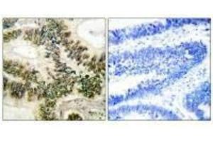 Immunohistochemical analysis of paraffin-embedded human colon carcinoma tissue using Cyclin E1 (Ab-395) antibody. (Cyclin E1 Antikörper  (Thr395))