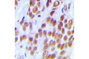 Immunohistochemical analysis of KDM1A staining in human breast cancer formalin fixed paraffin embedded tissue section.
