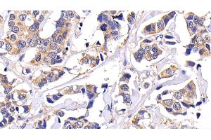 Immunohistochemistry (IHC) image for anti-Matrix Metallopeptidase 7 (Matrilysin, Uterine) (MMP7) (AA 1-267) antibody (ABIN7431014)