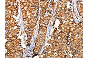 The image on the left is immunohistochemistry of paraffin-embedded Human breast cancer tissue using ABIN7192442(SLC25A3 Antibody) at dilution 1/35, on the right is treated with synthetic peptide. (SLC25A3 Antikörper)
