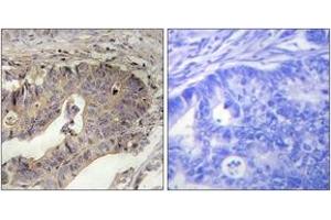 Immunohistochemistry analysis of paraffin-embedded human breast carcinoma tissue, using Fibrillin-1 Antibody. (Fibrillin 1 Antikörper  (AA 2811-2860))