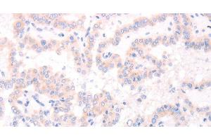 Immunohistochemistry of paraffin-embedded Human thyroid cancer tissue using AMH Polyclonal Antibody at dilution 1:30 (AMH Antikörper)