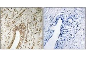 Immunohistochemistry analysis of paraffin-embedded human breast carcinoma tissue, using PHF3 Antibody. (PHF3 Antikörper  (AA 1990-2039))