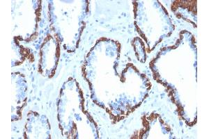 Formalin-fixed, paraffin-embedded human Prostate Carcinoma stained with Cytokeratin 13 Mouse Monoclonal Antibody (KRT13/2213).
