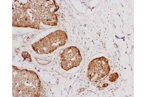 Expression of NTSR1 in human breast cancer - Immunohistochemical staining of human breast cancer cells using Anti-Neurotensin Receptor 1 (extracellular) Antibody (ABIN7043383, ABIN7044767 and ABIN7044768), (1:100). (NTSR1 Antikörper  (2nd Extracellular Loop))