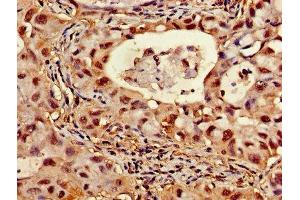 Immunohistochemistry of paraffin-embedded human lung cancer using ABIN7144848 at dilution of 1:100 (ATP5F1D Antikörper  (AA 23-168))