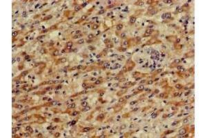 Immunohistochemistry of paraffin-embedded human liver cancer using ABIN7146606 at dilution of 1:100 (PRKACG Antikörper  (Catalytic Subunit gamma))