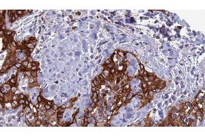 ABIN6277316 at 1/100 staining Human Head and neck cancer tissue by IHC-P. (CLEC4D Antikörper  (Internal Region))