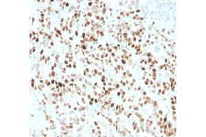 Formalin fixed paraffin embedded human colon carcinoma stained with p21 Rabbit Recombinant Monoclonal Antibody (CIP1/4377R). (Rekombinanter p21 Antikörper  (AA 1-100))