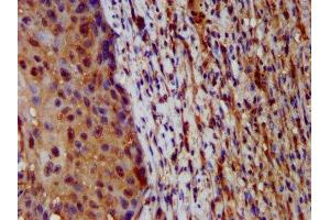 IHC image of ABIN7155245 diluted at 1:200 and staining in paraffin-embedded human lung cancer performed on a Leica BondTM system. (HAL Antikörper  (AA 36-152))