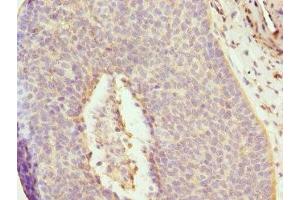 Immunohistochemistry of paraffin-embedded human cervical cancer using ABIN7150033 at dilution of 1:100 (DAAM2 Antikörper  (AA 1-86))
