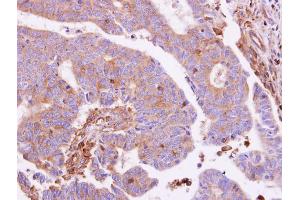 IHC-P Image G protein alpha Inhibitor 1 antibody detects GNAI1 protein at cytoplasm on human colon carcinoma by immunohistochemical analysis. (GNAI1 Antikörper  (Center))