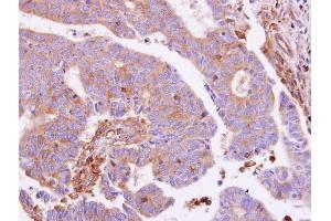 IHC-P Image G protein alpha Inhibitor 1 antibody detects GNAI1 protein at cytoplasm on human colon carcinoma by immunohistochemical analysis.