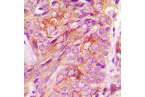 Immunohistochemical analysis of GRASP55 staining in human breast cancer formalin fixed paraffin embedded tissue section.