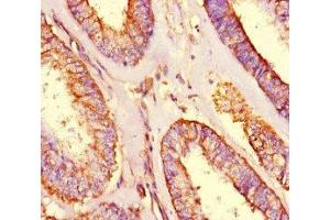 Immunohistochemistry of paraffin-embedded human endometrial cancer using ABIN7166128 at dilution of 1:100 (SHROOM3 Antikörper  (AA 1309-1571))