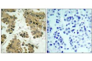 Immunohistochemical analysis of paraffin-embedded human lung carcinoma tissue using Akt2 (Ab-474) antibody (E021155). (AKT2 Antikörper)