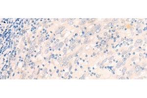 Immunohistochemistry of paraffin-embedded Human cervical cancer tissue using EME2 Polyclonal Antibody at dilution of 1:40(x200) (EME2 Antikörper)