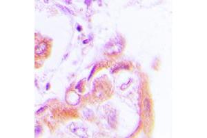Immunohistochemical analysis of AMPK beta 1 (pS182) staining in human lung cancer formalin fixed paraffin embedded tissue section. (PRKAB1 Antikörper  (pSer182))