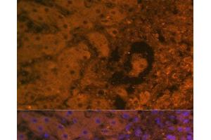 Immunofluorescence analysis of Human liver cancer using AFP Monoclonal Antibody at dilution of 1:100. (alpha Fetoprotein Antikörper)