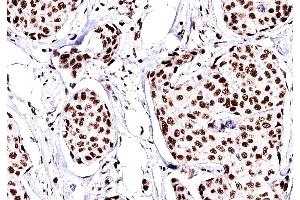 ABIN6269094 at 1/200 staining human Breast cancer tissue sections by IHC-P. (C-JUN Antikörper  (N-Term))