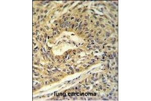 ATP5A1 Antibody (C-term) (ABIN653734 and ABIN2843039) IHC analysis in formalin fixed and paraffin embedded lung carcinoma followed by peroxidase conjugation of the secondary antibody and DAB staining. (ATP5A1 Antikörper  (C-Term))