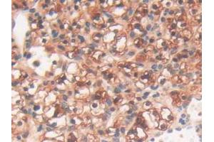IHC-P analysis of Human Kidney Cancer Tissue, with DAB staining. (PYGL Antikörper  (AA 370-538))