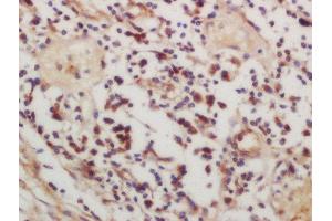 Formalin-fixed and paraffin embedded human lung carcinoma labeled with Rabbit Anti-CSK (Ser364) Polyclonal Antibody, Unconjugated  at 1:200 followed by conjugation to the secondary antibody and DAB staining (CSK Antikörper  (pSer364))