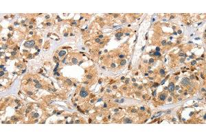 Immunohistochemistry of paraffin-embedded Human thyroid cancer using Cathepsin E Polyclonal Antibody at dilution of 1:40