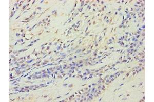 Immunohistochemistry of paraffin-embedded human breast cancer using ABIN7164537 at dilution of 1:100 (HARS2 Antikörper  (AA 34-506))