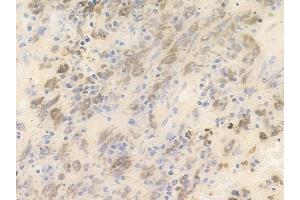 ABIN6255002 and ABIN6266460 at 1/100 staining human melanoma by IHC-P. (PAK3 Antikörper  (pSer154))